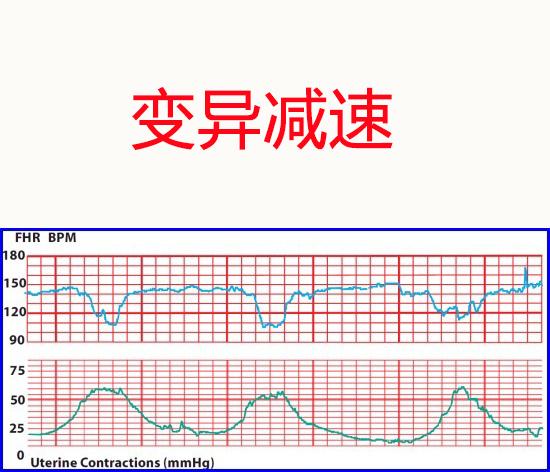 胎心监护的重要性及其适宜时间